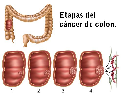 cancer-de-colon Test Septina9: la detección precoz del cáncer de colon