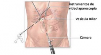 laparoscopia-350x193 Litiasis vesicular, algo más que piedras