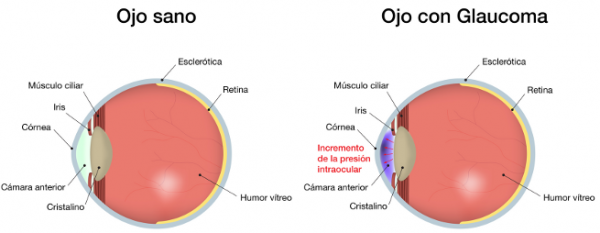 ojo-glaucoma-600x233 Glaucoma a raya gracias al té caliente