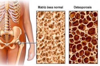 osteoporosis-350x233 Fracturas óseas por osteoporosis