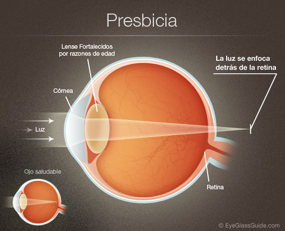 presbyopia ¡Ojo a la presbicia!