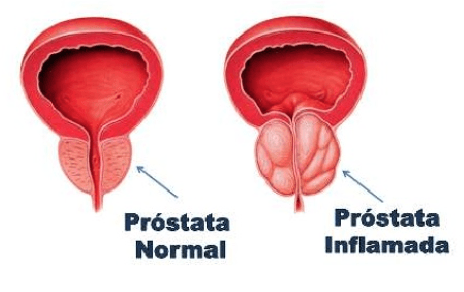prostata Día Europeo de la Salud Prostática: ¿padece prostatitis?