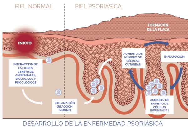 psoriasis-600x406 Identificada la molécula clave en el desarrollo de la psoriasis