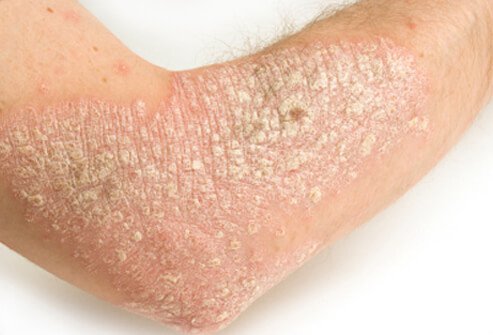 psoriasis Identificada una molécula en el desarrollo de la psoriasis