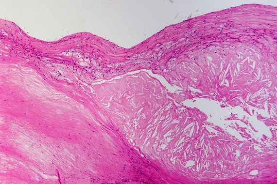 rellenan-celulas-con-colesterol-para-el-estudio-de-la-aterosclerosis_image_380 Estudian la aterosclerosis rellenando células con colesterol