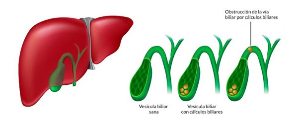 trat-calculos-biliares-600x248 Beneficios de la extirpación de la vesícula biliar