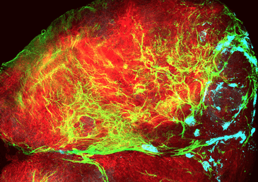 tumor Identificado el crecimiento celular de los tumores epiteliales