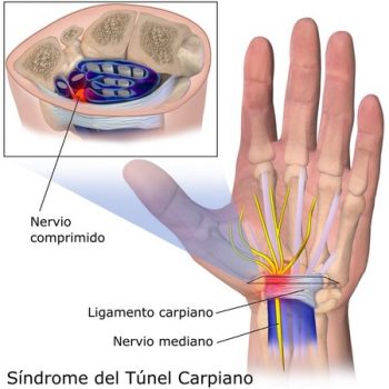 sindrome-tunel-carpiano-350x350 Síndrome del túnel carpiano: la Seguridad Social lo reconoce como enfermedad profesional