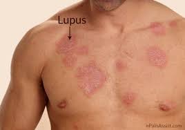 lupus El lupus ligado a desequilibrios bacterianos en la flora intestinal