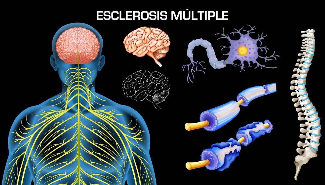 Esclerosis Múltiple: Una Nueva Terapia Eficaz Para Hacer Frente A Esta ...