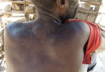 Un hombre de un pueblo cerca del parque nacional Messok Dja muestra cicatrices de golpes recibidos por guardaparques. © Fiore Longo.Survival.