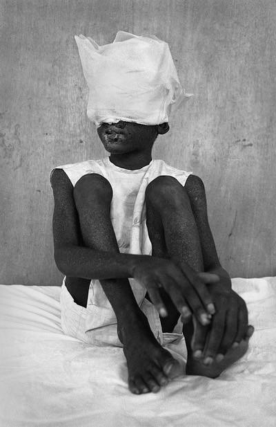 Sandra Balsells: Mackenson, cinco años, poco antes de morir por cáncer de piel. Hospital Saint Damien, Puerto Principe, Haití 2002
