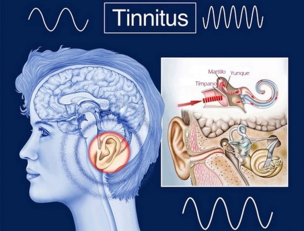 tinnitus-2-600x457 ¿Tinnitus o estrés?