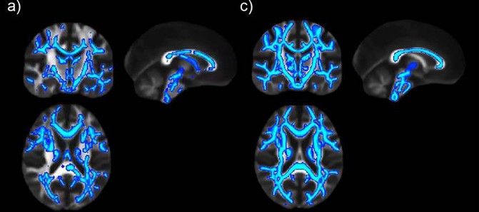 cerebros_image671_405 El daño cerebral permanece aunque se haya dejado de beber