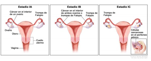 cancer-de-ovarios-600x245 Cáncer de ovario: la enfermedad invisible