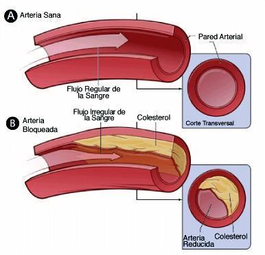 colesterol-bueno-y-malo-arteria-sana Colesterol y enfermedades cardiovasculares