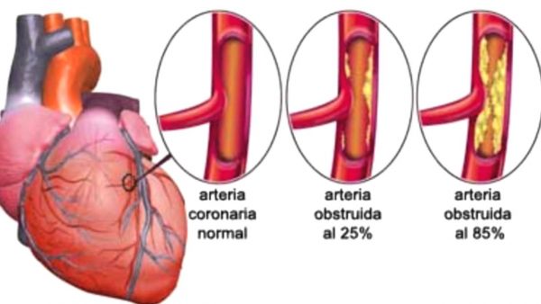 infarto-de-miocardio-600x338 Infarto de miocardio: cuando el corazón dice para