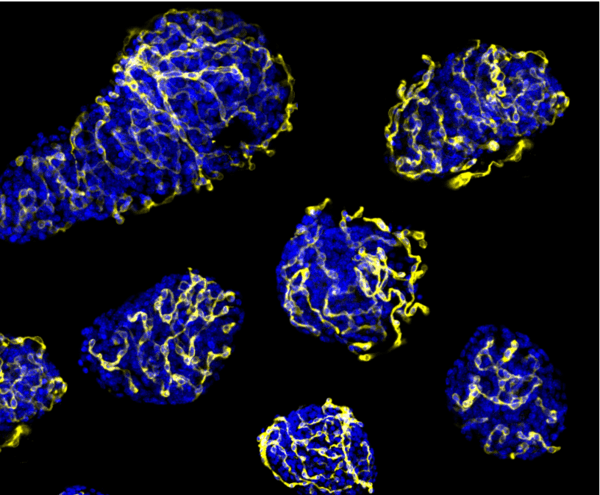 islotes-pancreaticos_imagelarge-600x495 Diabetes tipo 1: nuevo abordaje con medicina regenerativa