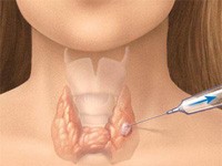 diagnostico-nodulo PAAF: una prueba para analizar el bocio multinodular