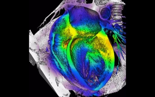 esclerostina-600x375 Enfermedad cardiovascular: la esclerostina clave para predecir la muerte