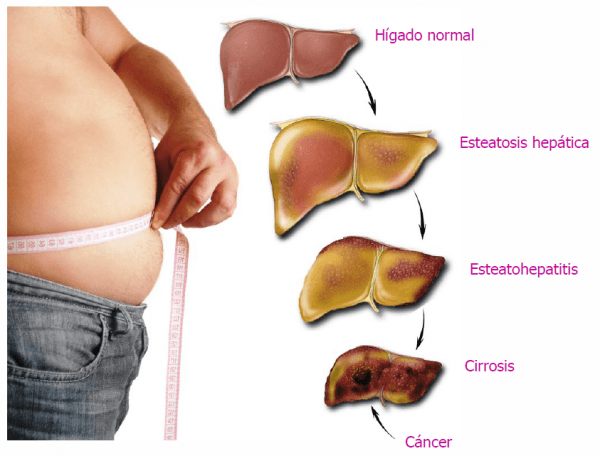 higado-graso-2-600x456 Cirrosis: un nuevo hallazgo científico permitirá diagnosticar antes la enfermedad