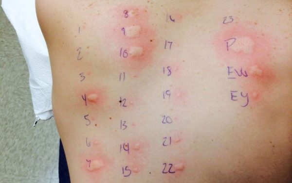 pruebas-de-alergia-con-parches-600x377 Anafilaxia: un cuadro infradiagnosticado que puede ser mortal