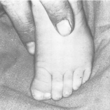 SaeChotSyn_Reardon1994_hallux-duplication-350x350 Craneoestenosis: una enfermedad rara y desconocida que padecen algunos bebés