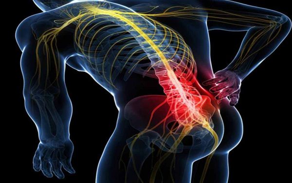 ciatica-600x375 Ciática: un dolor incapacitante