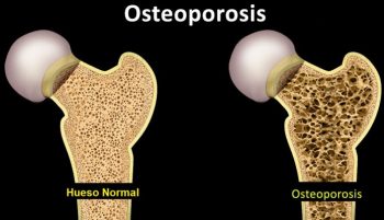 arton5596-350x201 Osteoporosis: no dejes que fracture tu futuro