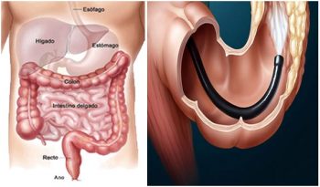 colonoscopia-350x205 Colonoscopia: el tercer cáncer evitable gracias a la prevención