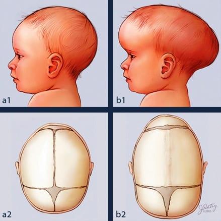 Craneosinostosis-Síntomas-tipos-tratamiento-y-opciones-quirúrgicas Craneosinostosis: el cierre prematuro o total de una o más suturas craneales