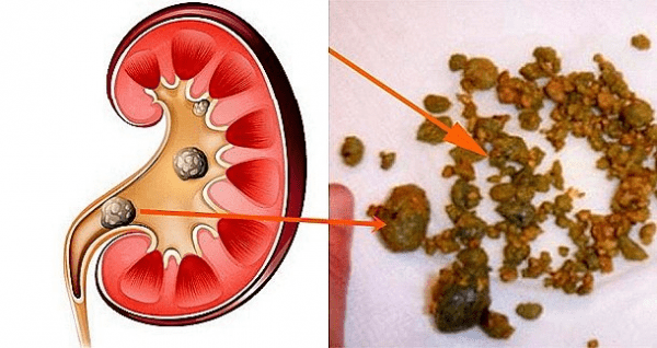 litiasis-600x318 Arenilla en el riñón: una alerta dolorosa