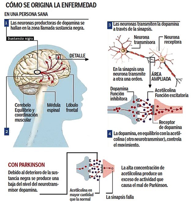 parkinson Día Mundial del Párkinson: la enfermedad que no cesa