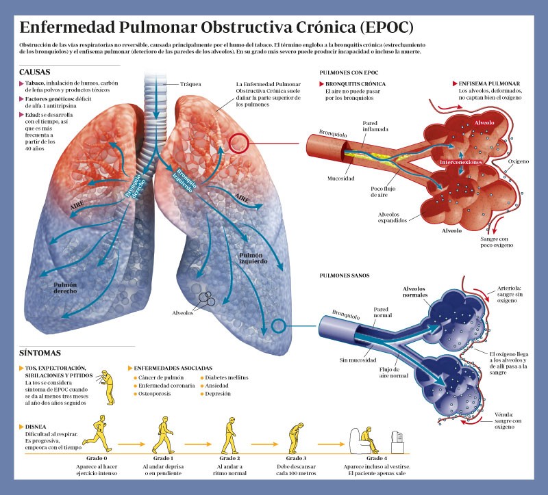 EPOC-infografia-principal-tablet EPOC: la silente enfermedad pulmonar