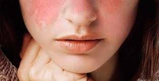 lupus-nariz Enfermedades crónicas: el día a día con el lupus