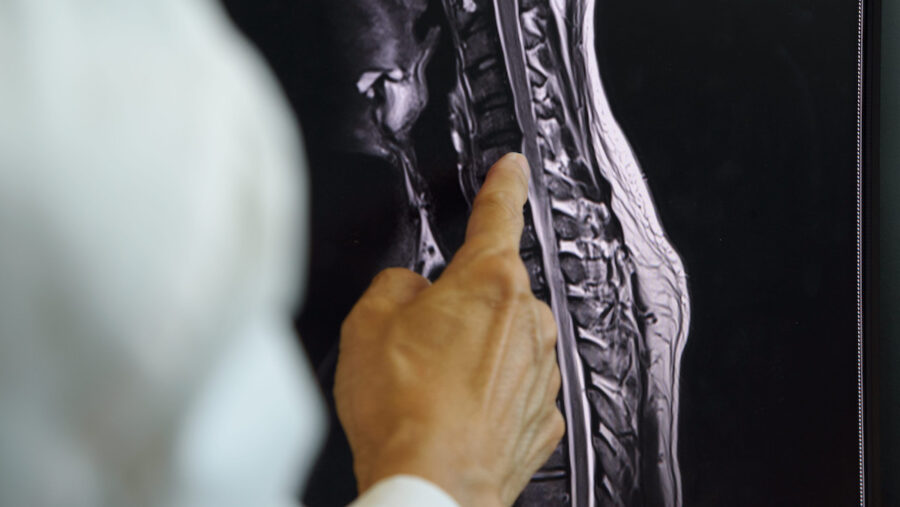 Cirugia-columna-vertebral-©123RF-e1776616696454-900x507 El Máster en Cirugía en Columna Vertebral de ISEIE te posiciona en un mercado global que supera los 16.000 millones de dólares