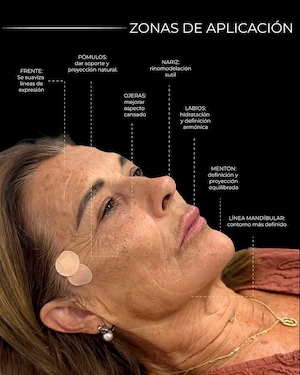 profhilo-©mandibuladediamante Profhilo: el tratamiento que está revolucionando el rejuvenecimiento facial sin cirugía