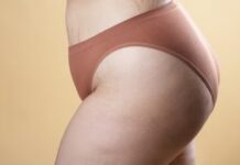 Lipedema y sus síntomas para reconocer esta enfermedad