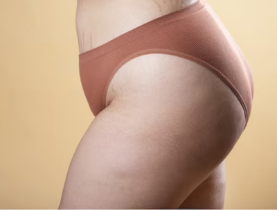 Lipidemia-©archivopub Lipedema y sus síntomas para reconocer esta enfermedad