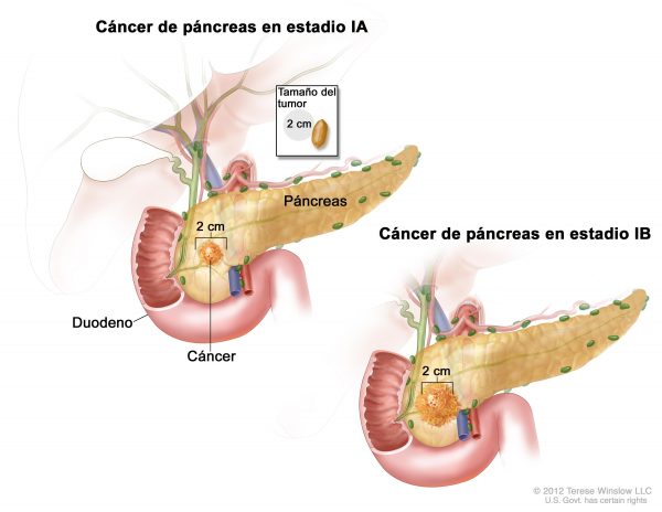 CDR743858-600x464 Nuevo hallazgo en torno al cáncer de páncreas