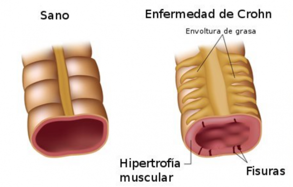 Captura-de-pantalla-2018-01-11-a-las-14.42.00-600x384 Enfermedad de Crohn, cuando el intestino se queja