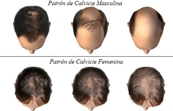 Captura-de-pantalla-2018-01-28-a-las-19.27.13 Alopecia: mitos y verdades