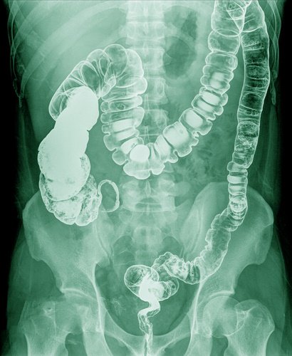 Intestino-cargado-rayos-x-retener-las-heces Probióticos: ventajas e inconvenientes de su ingesta