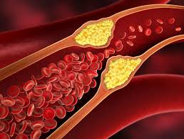 arteria-obstruida Salud: Vinculan la obesidad visceral y la enfermedad cardiovascular