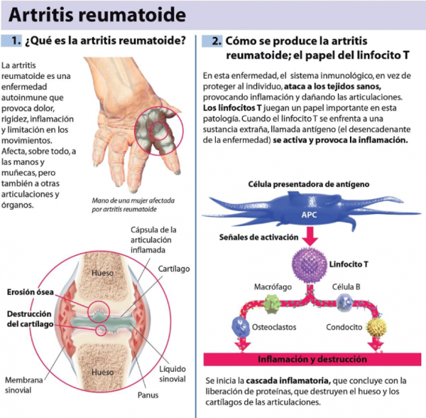 artritis-reumatoide-600x588 Artritis reumatoide, cuando se convive con dolor crónico