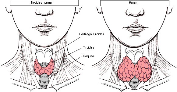 bocio Bocio nodular y multinodular, ¿es grave?