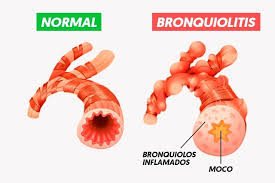 bronquiolitis Repunte de bronquiolitis, la infección de los bebés