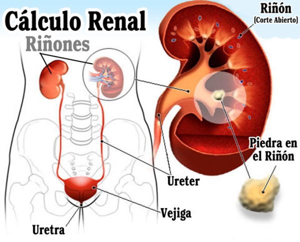 calculos-renales680-600x484 Piedras en el riñón, un dolor incapacitante