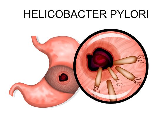 causas-de-la-Helicobacter-pylori Helicobacter Pylorí, algo más que una bacteria