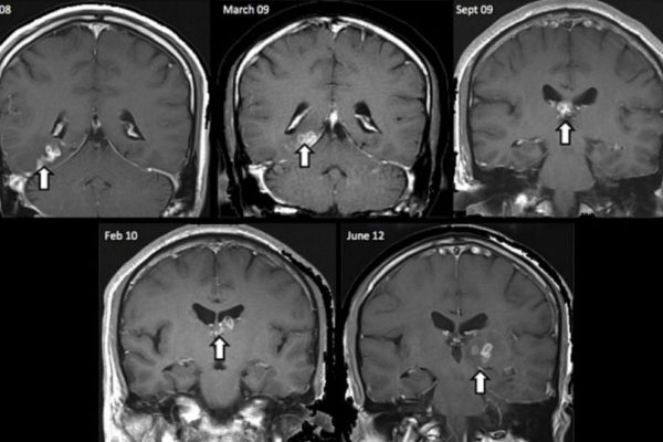 cisticercosis-600x400 Cisticercosis: Aumento significativo de casos en España